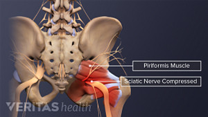 Posterior view of the pelvis labeling the piriformis muscle and the compressed sciatic nerve