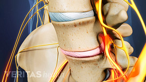 Anterior view of pain in the disc between two lumbar vertebrae.