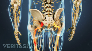 Posterior view of pain radiating down the sciatic nerve in the leg.