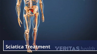 Lower body skeleton showing sciatica