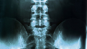 X-ray view of the lumbar spine and pelvis.