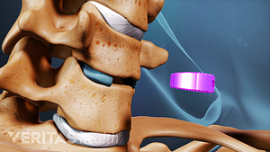 Artificial disc being inserted in the cervical spine.