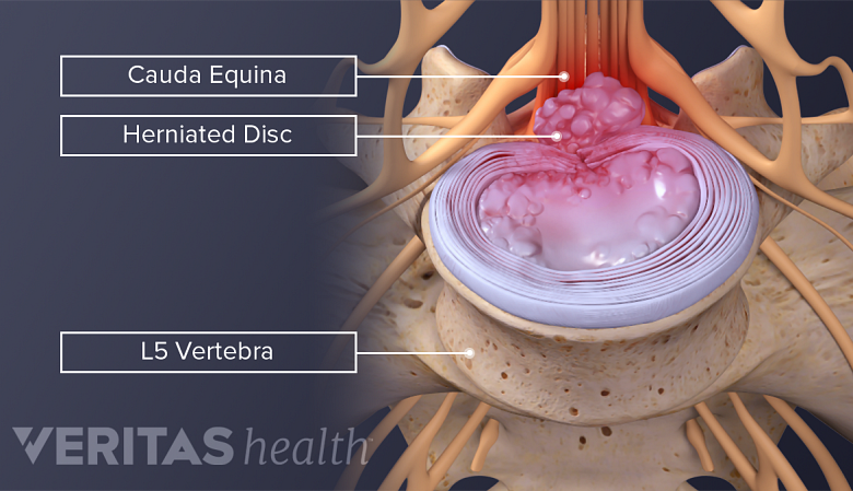 A severely herniated disc pressing on the cauda equina nerves in the lower spine.