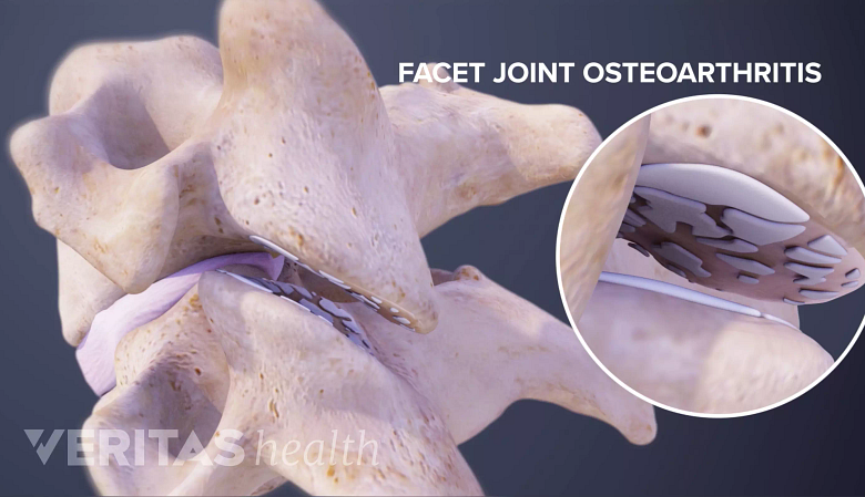 Posterior view 3D image depicting facet joint osteoarthritis.
