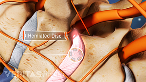 Medical illustration showing a herniated disc in the cervical spine