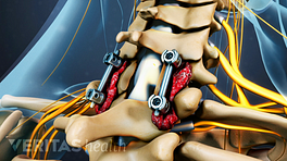 Posterior view of fusion screws in the cervical spine.
