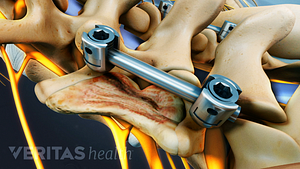 Fusion rods in the lumbar spine.