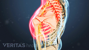 Medical illustration of the upper body, with one shoulder highlighted in red showing nerve pain in the shoulder and arm