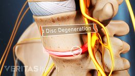 Sciatica pain caused by disc degeneration.