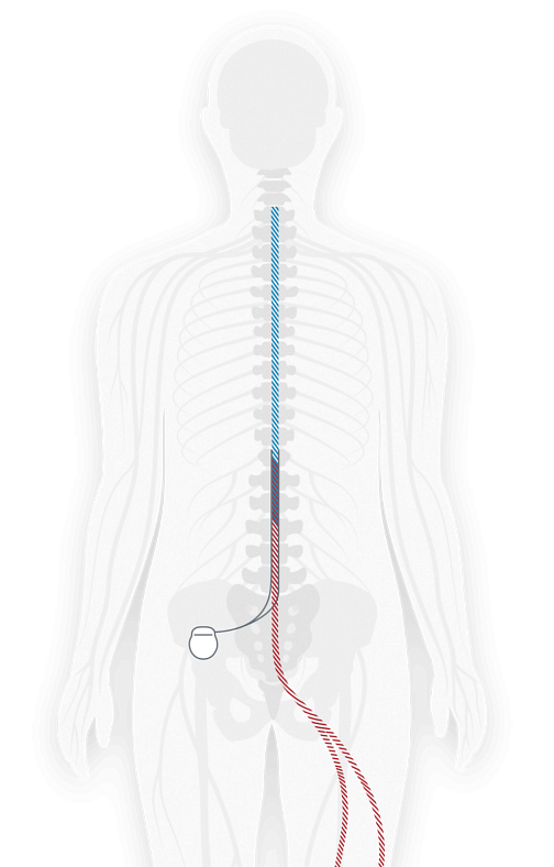 Illustration showing where a spinal cord stimulator is implanted in the body and attached to nerves near the spine to send pulses to the nerves to relieve pain.