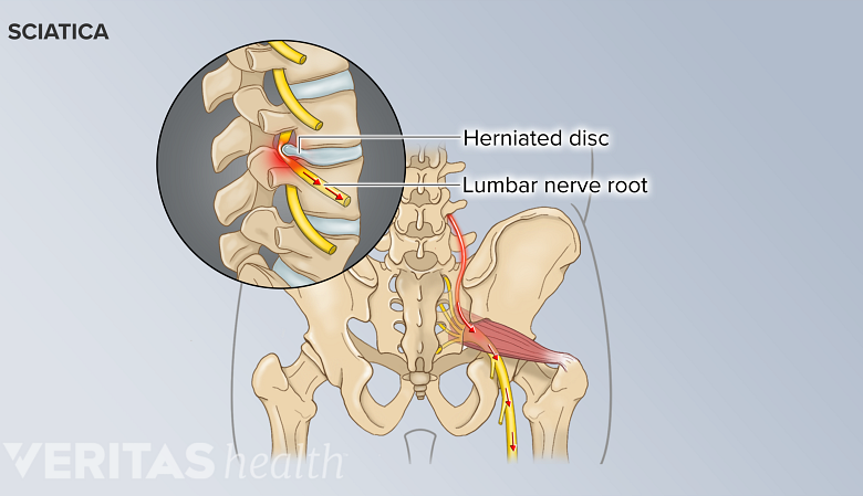 A herniated disc in the lower back pinching the sciaitc nerve root, sending pain signals down the sciatic nerve.