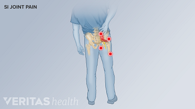 Illustration representing pain pattern of SI joint pain in the lower back and thigh on the right side.